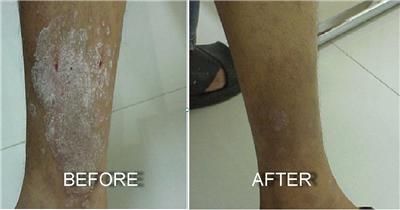 100% NATURAL HERBAL OINTMENT/CREAM FOR PSORIASIS, 2 x 10 g.  